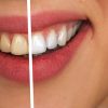 Best Selling Teeth Whiteners & Whitening Systems