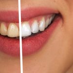 Best Selling Teeth Whiteners & Whitening Systems